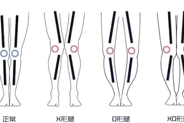 八字脚图片展示:如何辨识与矫正八字脚问题 八字脚图片展示:如何辨识与矫正八字脚问题